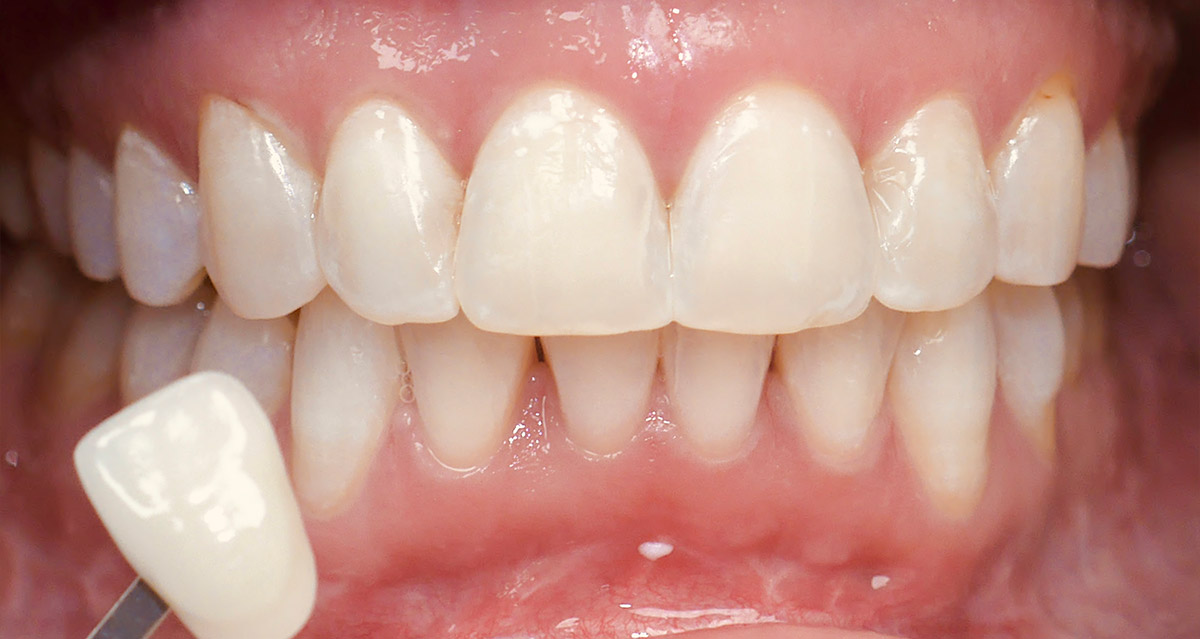 images/bleaching/bleaching-nachher-leistungen.jpg#joomlaImage://local-images/bleaching/bleaching-nachher-leistungen.jpg?width=1200&height=639