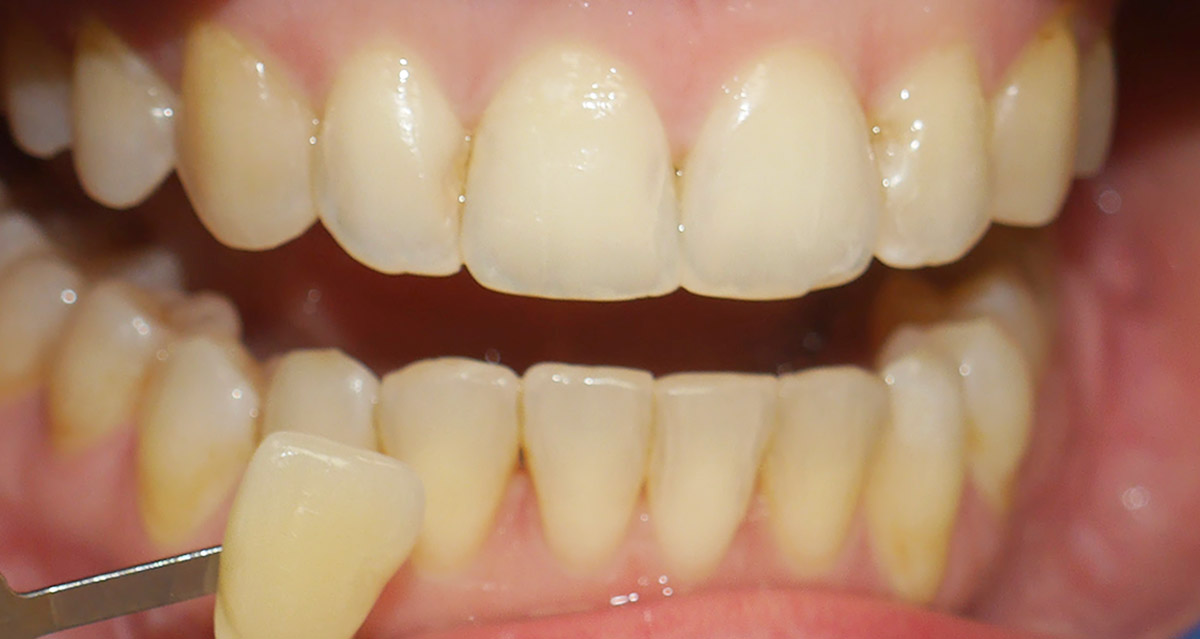 images/bleaching/bleaching-vorher-leistungen.jpg#joomlaImage://local-images/bleaching/bleaching-vorher-leistungen.jpg?width=1200&height=639