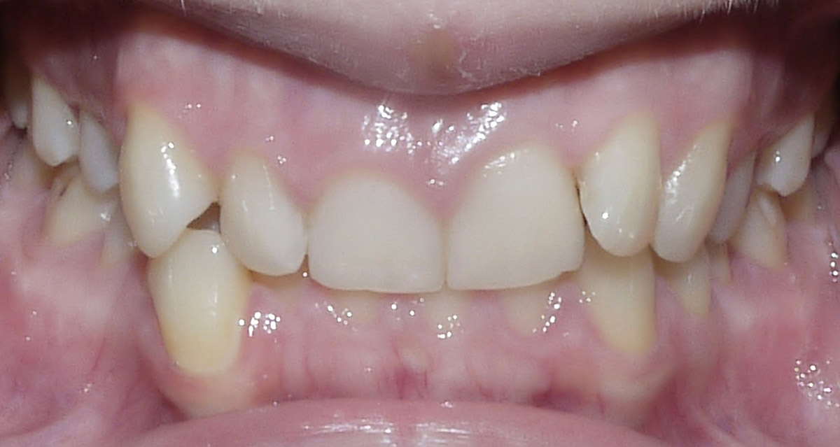 images/kieferorthopaedie/01-kieferorthopaedie_vorher1.jpg#joomlaImage://local-images/kieferorthopaedie/01-kieferorthopaedie_vorher1.jpg?width=1200&height=639