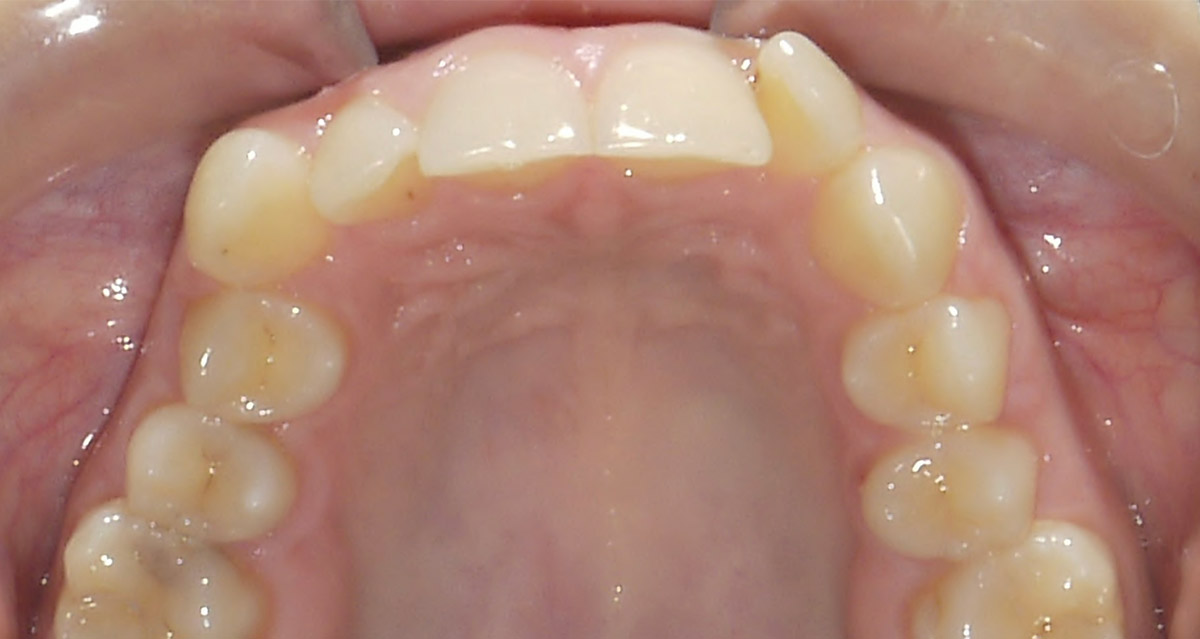 images/kieferorthopaedie/02-kieferorthopaedie_vorher2.jpg#joomlaImage://local-images/kieferorthopaedie/02-kieferorthopaedie_vorher2.jpg?width=1200&height=639