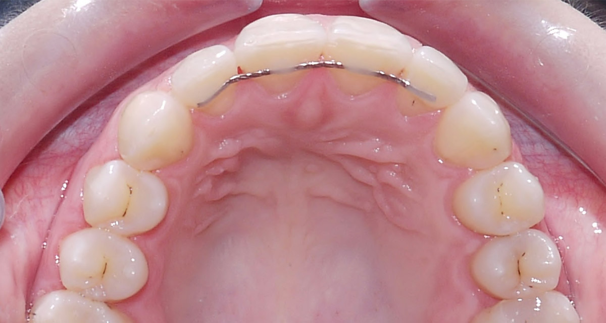 images/kieferorthopaedie/05-kieferorthopaedie_nachher5.jpg#joomlaImage://local-images/kieferorthopaedie/05-kieferorthopaedie_nachher5.jpg?width=1200&height=639